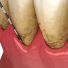歯周病